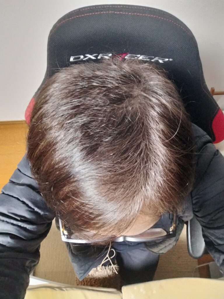 AGA治療4ヶ月目